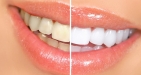 Express Teeth Whitening
