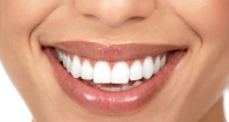 Blanqueamiento dientes a domicilio